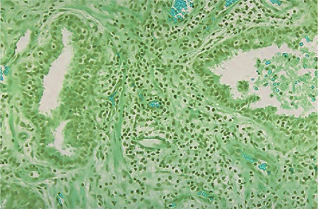 calcificazioni stomaco prostata